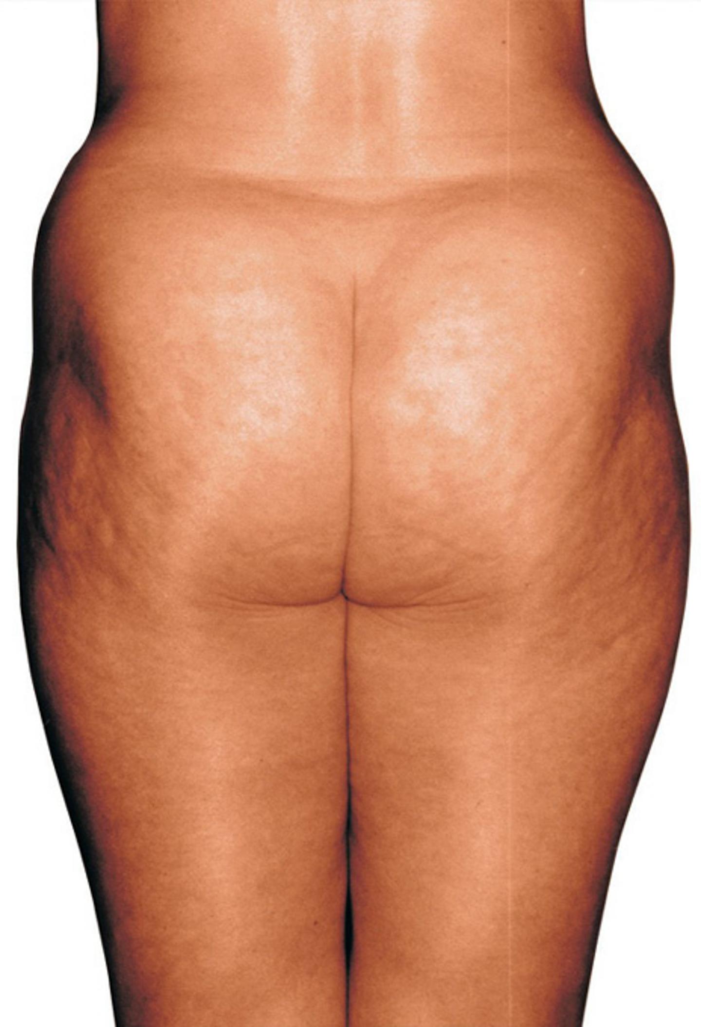 Cellulite vor Endermologie-Behandlung